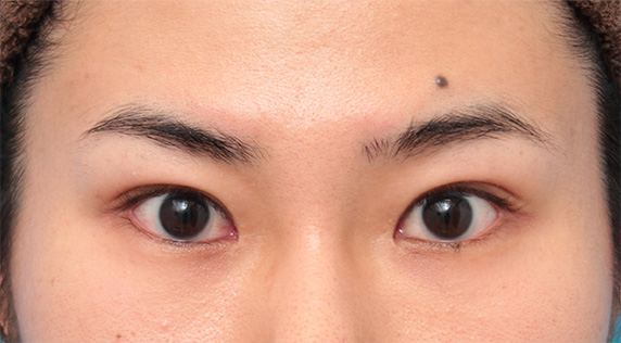目尻切開 タレ目形成 グラマラスライン で目を一回り大きくした男性の症例写真の術前術後画像 美容外科 高須クリニック