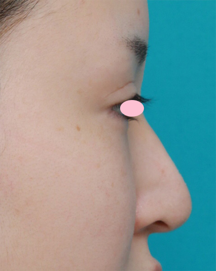 鼻尖形成（鼻尖縮小・だんご鼻修正）,鼻尖形成手術でダンゴ鼻を細くした症例写真,After（3ヶ月後）,ba_bisen22_b.jpg