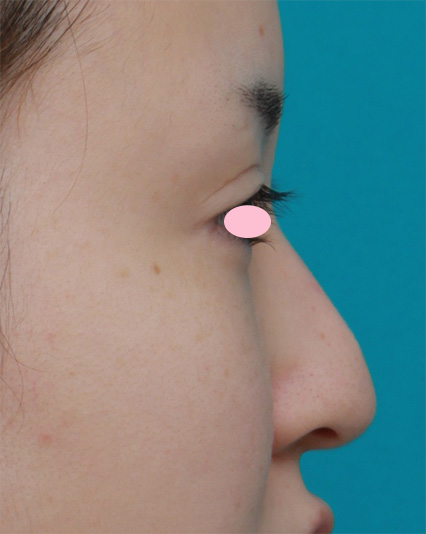 鼻尖形成（鼻尖縮小・だんご鼻修正）,鼻尖形成手術でダンゴ鼻を細くした症例写真,Before,ba_bisen22_b.jpg