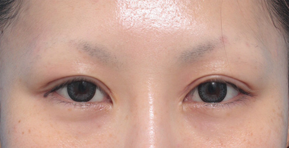 眼瞼下垂（がんけんかすい）,他院で受けた手術の修正（二重まぶた・目もと）,他院で行われた二重まぶた切開法に対し、眼瞼下垂手術で二重の幅を狭く修正した症例写真,After（4ヶ月後）,ba_ganken42_a01.jpg
