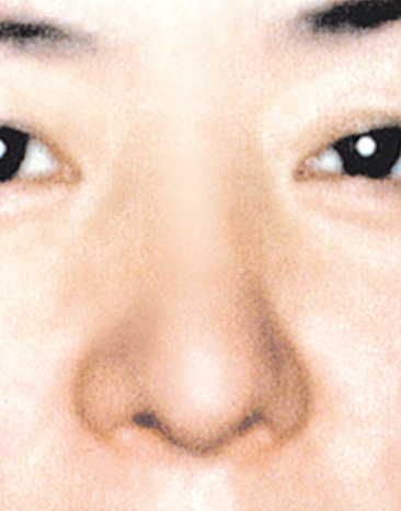 鼻尖形成（鼻尖縮小・だんご鼻修正）,鼻尖形成（鼻尖縮小・だんご鼻修正）の症例写真,After,ba_bisen08_b.jpg