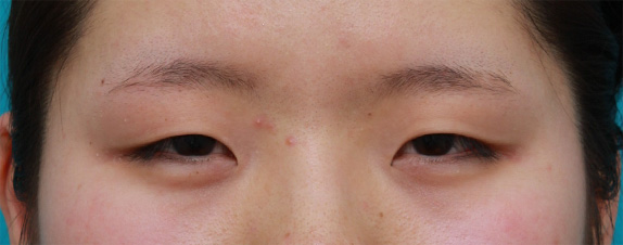 目頭切開,眼瞼下垂（がんけんかすい）,目頭切開+眼瞼下垂手術で小さい目を一回り大きくした症例写真,Before,ba_ganken45_b.jpg
