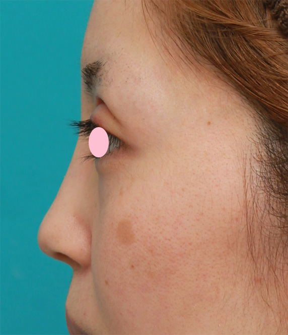 鼻尖形成（鼻尖縮小・だんご鼻修正）,鼻尖縮小+鼻先の耳介軟骨移植で、団子鼻をすっきりさせた症例写真,After（6ヶ月後）,ba_bisen26_b.jpg