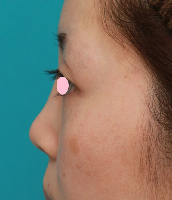 鼻尖形成（鼻尖縮小・だんご鼻修正）,鼻尖縮小+鼻先の耳介軟骨移植で、団子鼻をすっきりさせた症例写真,Before,ba_bisen26_b.jpg
