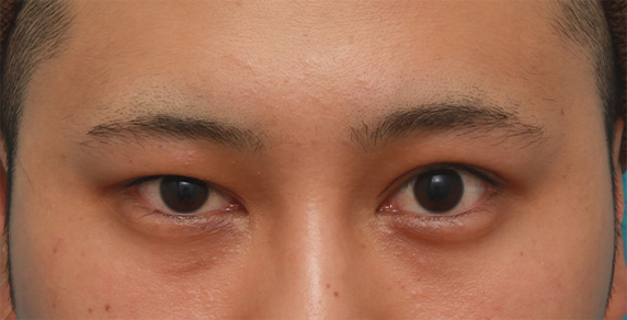 片目の眼瞼下垂を手術で治し ほぼ左右対称にした症例写真 美容整形の高須クリニック 東京赤坂 横浜 名古屋 大阪