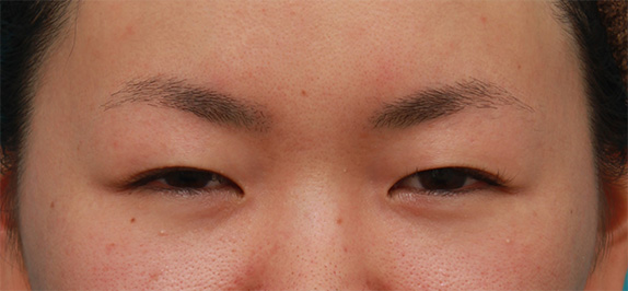 黒目を大きくする手術はあるのか 眼瞼下垂手術や目頭切開などで黒目は大きくなるのか Dr 高須幹弥の美容整形講座 美容整形の高須クリニック
