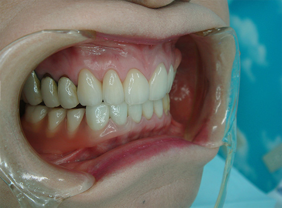 症例写真,義歯・入れ歯の症例写真　オールセラミッククラウン（e-max）も施行,After（義歯あり）,