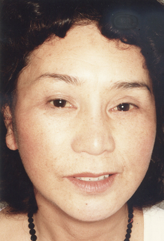 フルフェイスリフト,額リフト（額のしわ取り手術）,フルフェイスリフトを行った82歳女性の症例写真,After,ba_facelift_pic14_a01.jpg