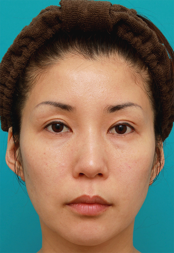 40代女性の顔全体にイタリアンリフトファインを行い、肌の張りを出した症例写真の術前術後画像 ： 美容整形の高須クリニック（東京赤坂・横浜