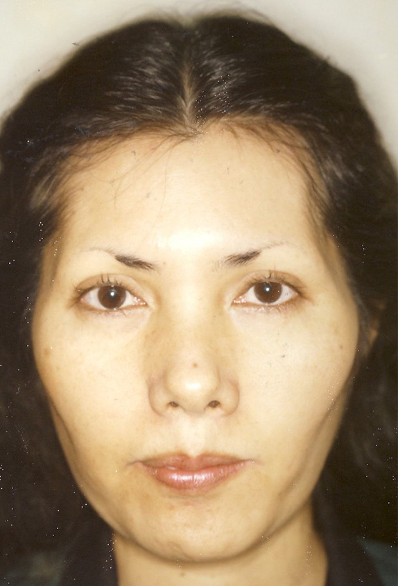 顔面脂肪注入の症例写真　頬とこめかみに脂肪注入,Before,ba_faceshibo_pic03_b.jpg