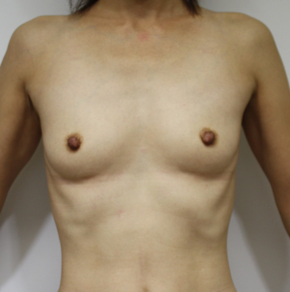 豊胸手術（シリコンプロテーゼ）,豊胸手術（シリコンプロテーゼ）の症例 大胸筋下に100ccずつ挿入,Before,ba_hokyo17_b.jpg