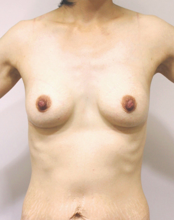 豊胸手術（シリコンプロテーゼ）,授乳後の萎んで垂れたバストに乳腺下100ccのシリコンプロテーゼで豊胸手術した症例写真,After,ba_hokyo51_a01.jpg