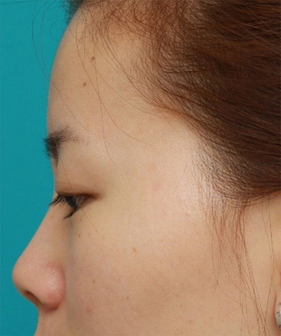 CO2レーザー,顔のホクロをCO2レーザーで除去した症例写真,After（6ヶ月後）,ba_hokuro_ibo_aza24_b.jpg