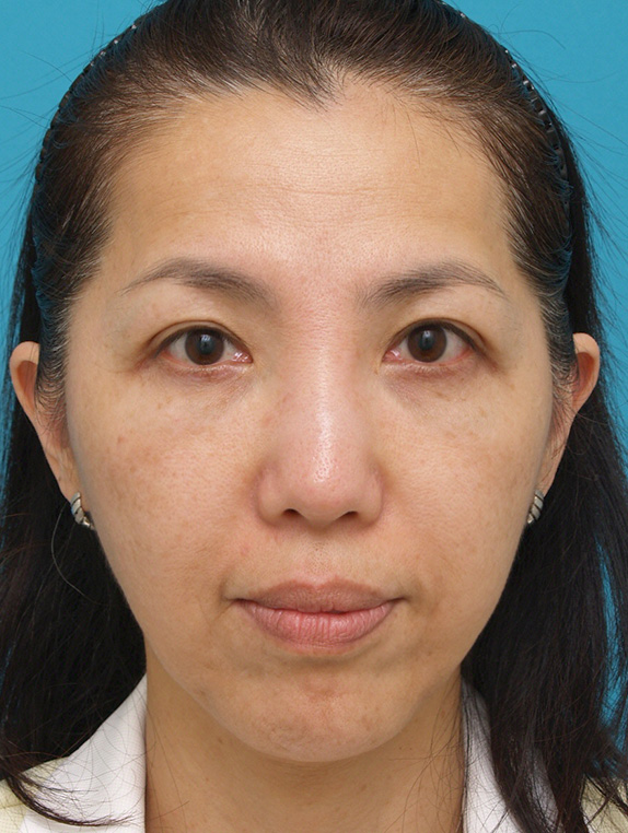 ウルセラシステム,ウルセラシステムの症例 頬と首がたるみブルドッグ様の老化が見られた40代女性,After（3ヶ月後）,ba_ulthera_pic06_a01.jpg