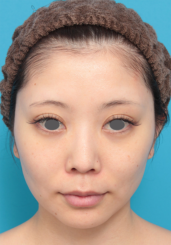 代女性にウルセラシステムを行い 頬のたるみが引き締まり小顔になった症例写真 美容整形の高須クリニック 東京赤坂 横浜 名古屋 大阪