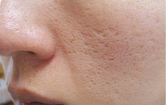ダーマローラー 回転式皮膚点状治療 肌 美容皮膚科 美容整形の高須クリニック