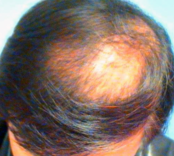 症例写真,AGA治療（高須式メディカル育毛プログラム）の症例写真18　HARG療法を施術,Before,ba_aga_18_b.jpg