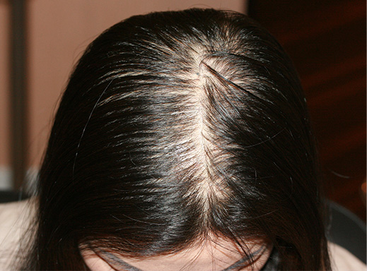 AGA治療（高須式メディカル育毛プログラム）,女性の薄毛治療,女性の薄毛治療（HARG療法）の症例 HARG療法を5回施術,Before,ba_aga_15_b.jpg