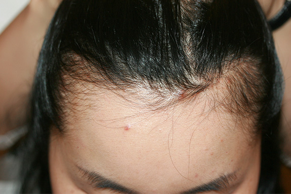 女性で額 おでこ が広い人を狭くする治療はあるのか 植毛手術などは有効か 男性の場合は Dr 高須幹弥の美容整形講座 美容整形の高須クリニック