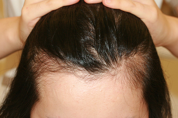 AGA治療（高須式メディカル育毛プログラム）,女性の薄毛治療（HARG療法）の症例写真,Before,ba_aga_13_b.jpg