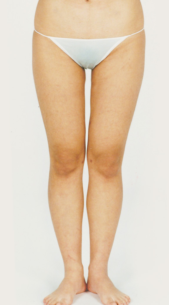 脂肪吸引,脂肪吸引の症例写真　大腿,After,ba_shibokyuin31_a01.jpg