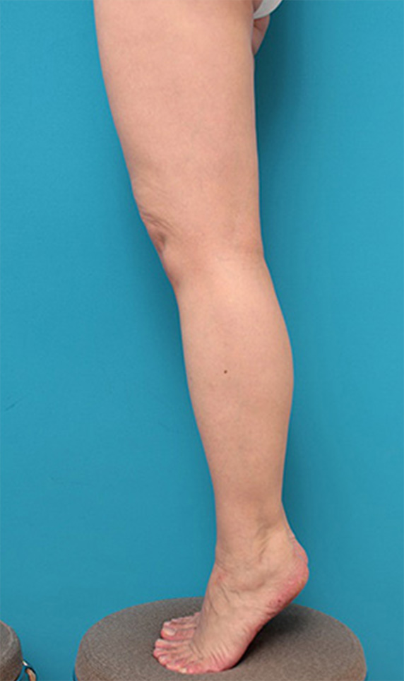 症例写真,ボツリヌストキシン注射（ふくらはぎ・足やせ・美脚）の症例,After（6ヶ月後）,ba_leg18_b.jpg