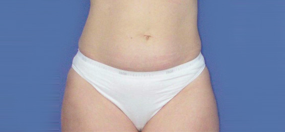 イタリアン・メソシェイプ（イタリアンメソセラピー）・脂肪溶解注射,イタリアン・メソシェイプ（イタリアンメソセラピー）・脂肪溶解注射の症例 腹部まわりのたるみを気にされていた女性,Before,ba_meso15_b.jpg