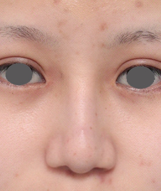 鼻尖形成（鼻尖縮小・だんご鼻修正）,鼻プロテーゼ+鼻尖形成（鼻尖縮小）症例写真,After,ba_ryubi35_b.jpg