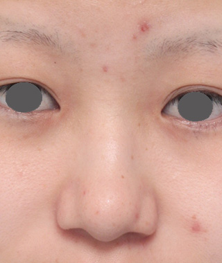 鼻尖形成（鼻尖縮小・だんご鼻修正）,鼻プロテーゼ+鼻尖形成（鼻尖縮小）症例写真,Before,ba_ryubi35_b.jpg
