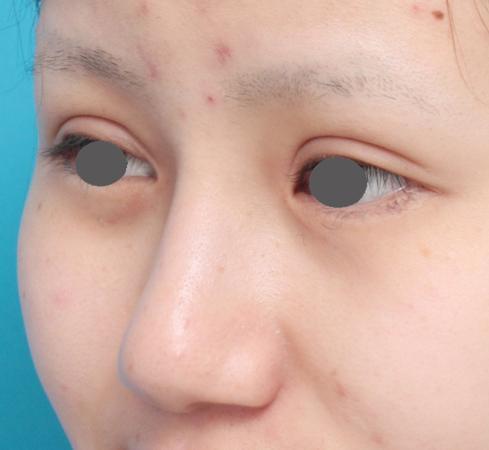 鼻尖形成（鼻尖縮小・だんご鼻修正）,鼻プロテーゼ+鼻尖形成（鼻尖縮小）症例写真,After（メイクなし）,ba_ryubi36_b.jpg