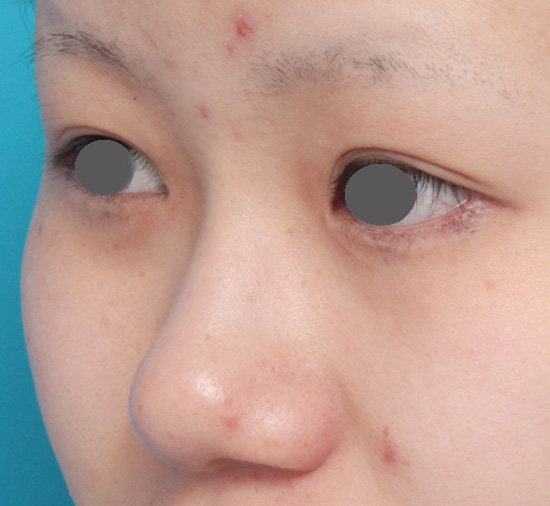 鼻尖形成（鼻尖縮小・だんご鼻修正）,鼻プロテーゼ+鼻尖形成（鼻尖縮小）症例写真,Before,ba_ryubi36_b.jpg