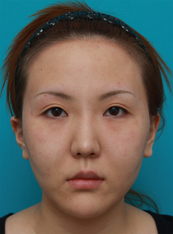 頬、顎にイタリアン・メソシェイプ（イタリアンメソセラピー）・脂肪溶解注射を3回行い、小顔になった症例写真,After（3回目終了後2ヶ月後）,ba_meso49_a01.jpg