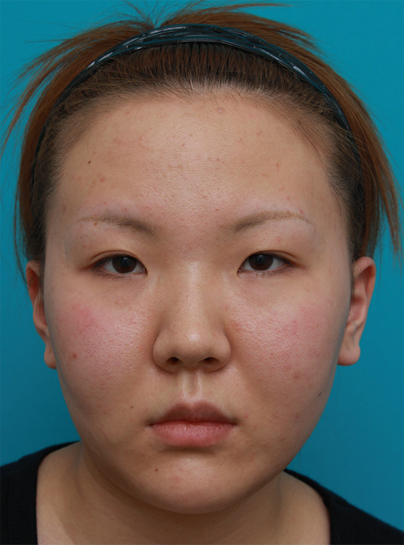 頬、顎にイタリアン・メソシェイプ（イタリアンメソセラピー）・脂肪溶解注射を3回行い、小顔になった症例写真,Before,ba_meso49_b.jpg