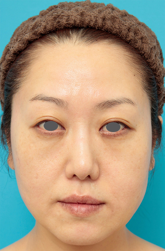 バッカルファット除去手術の症例写真 美容整形の高須クリニック 東京赤坂 横浜 名古屋 大阪