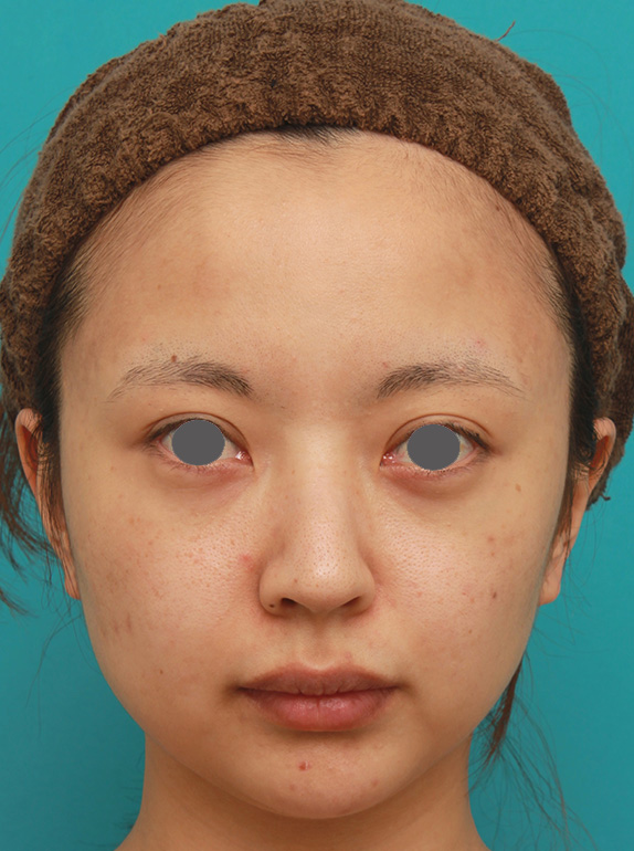 小顔専用脂肪溶解注射メソシェイプフェイスでほっそりすっきりした症例写真の術前術後画像 美容外科 高須クリニック