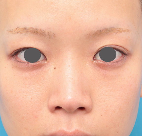 隆鼻術（シリコンプロテーゼ）,鼻翼縮小（小鼻縮小）,耳介軟骨移植（鼻先を出す）,鼻プロテーゼと耳介軟骨移植と小鼻縮小を同時に行った症例写真,Before,ba_ryubi1035_b01.jpg