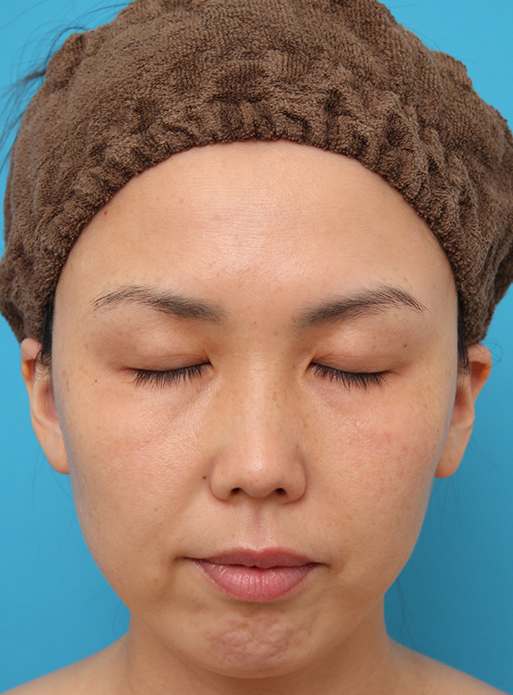 【症例写真】二重まぶた埋没法2針固定でたるんでいる皮膚を持ち上げて目を大きくした30代女性の症例：美容外科 高須クリニック