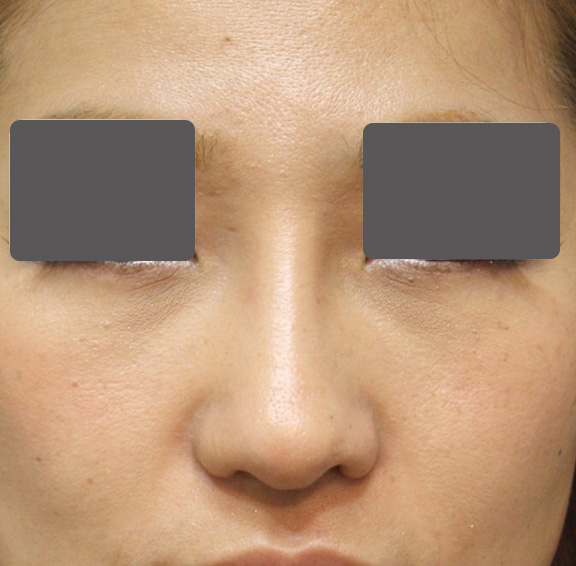 鼻翼縮小（小鼻縮小）,5mmの鼻シリコンプロテーゼ+小鼻（鼻翼）縮小手術を行った20代女性の症例写真,After（6ヶ月後）,ba_ryubi1037_b01.jpg