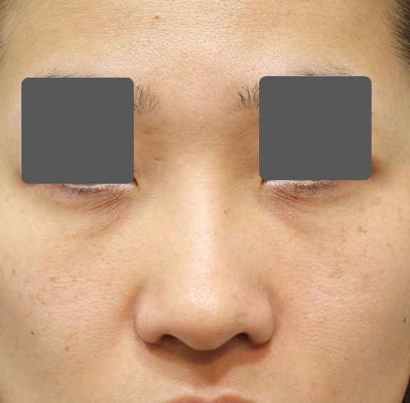 鼻翼縮小（小鼻縮小）,5mmの鼻シリコンプロテーゼ+小鼻（鼻翼）縮小手術を行った20代女性の症例写真,Before,ba_ryubi1037_b01.jpg