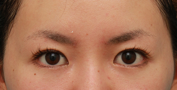 目尻切開,垂れ目（パンダ目）形成（グラマラスライン／下眼瞼下制術）,目尻切開とタレ目形成（グラマラスライン）を同時に行った20代女性の症例写真,After（6ヶ月後）,ba_mejiri013_a01.jpg