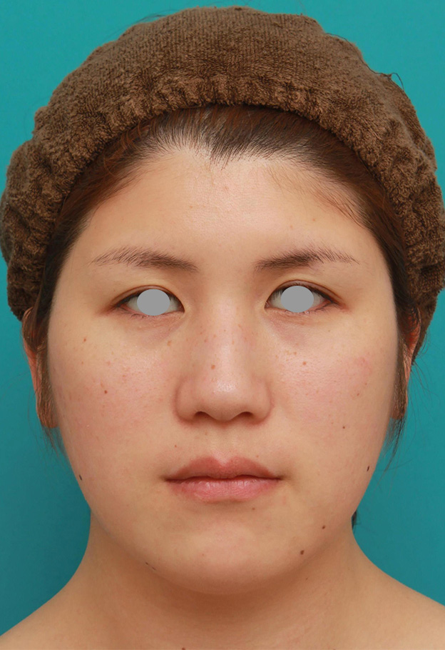 脂肪吸引（頬、あご）,頬、フェイスライン、二重顎の脂肪吸引をして小顔になった症例写真,手術前,mainpic_shibo003a.jpg