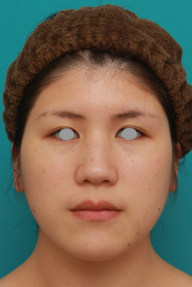 脂肪吸引（頬、あご）,頬、フェイスライン、二重顎の脂肪吸引をして小顔になった症例写真,3週間後,mainpic_shibo003d.jpg