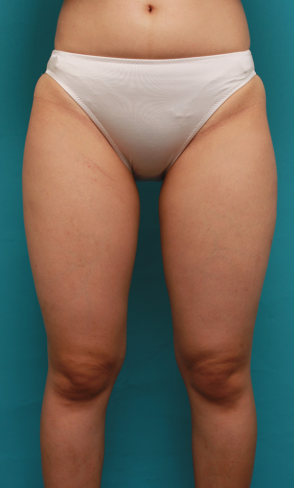 太もも全体にイタリアン・メソシェイプ（イタリアンメソセラピー）・脂肪溶解注射をして、一回り細くなった症例写真,Before,ba_meso037_b01.jpg