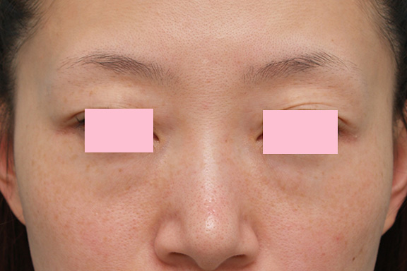 症例写真,目の下のゴルゴ線をヒアルロン酸注射で改善させた症例写真,Before,ba_golgo005_b01.jpg