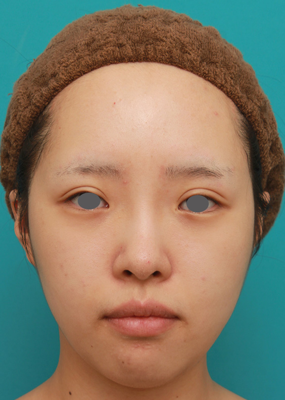 顔の脂肪溶解注射をした後 ボツリヌストキシン注射 エラ プチ小顔術 をし 更に小顔になった代女性の症例写真 美容外科 高須クリニック
