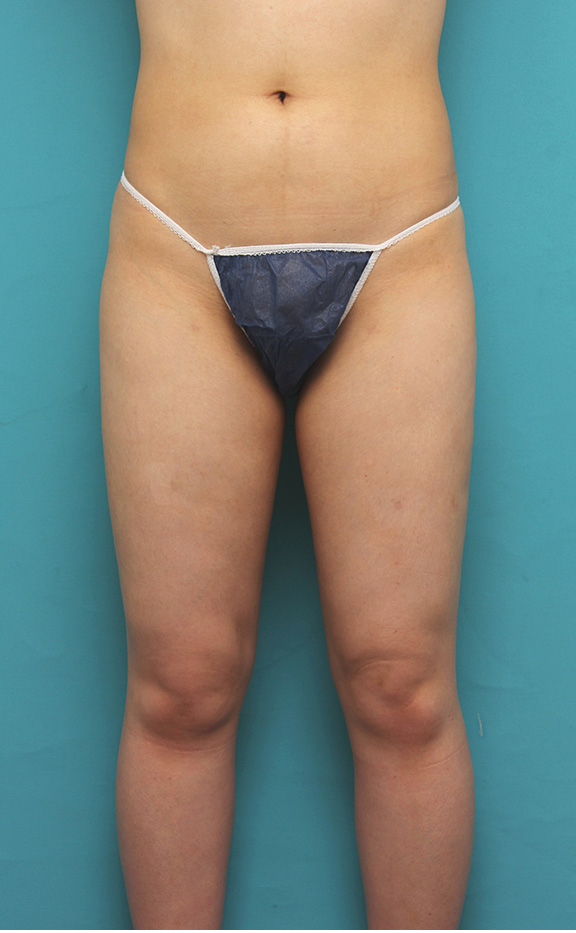 20代女性のお尻と太もも全体の脂肪吸引をした症例写真,After（6ヶ月後）,ba_shibokyuin033_a01.jpg