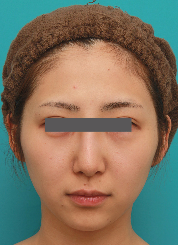 小顔専用脂肪溶解注射メソシェイプフェイスで小顔になった症例写真