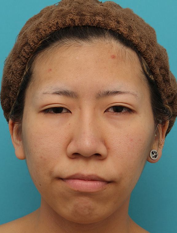 鼻尖形成（鼻尖縮小・だんご鼻修正）,20代女性の、総合的なお鼻のお悩みを手術で改善した症例写真,After（6ヶ月後メイクなし）,ba_ryubi1052_b01.jpg