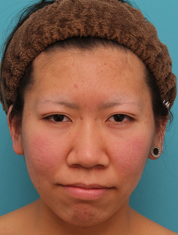 鼻尖形成（鼻尖縮小・だんご鼻修正）,20代女性の、総合的なお鼻のお悩みを手術で改善した症例写真,Before,ba_ryubi1052_b01.jpg