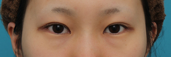目尻切開,目尻切開と下まぶた逆さまつ毛の同時手術の症例写真,After（3ヶ月後）,ba_mejiri020_b01.jpg